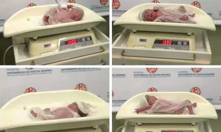 Mulher da a luz a quadrigêmeos no Vale, segundo médico, probabilidade de um em cada 600 casos