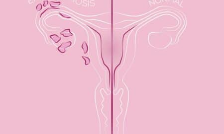 Endometriose