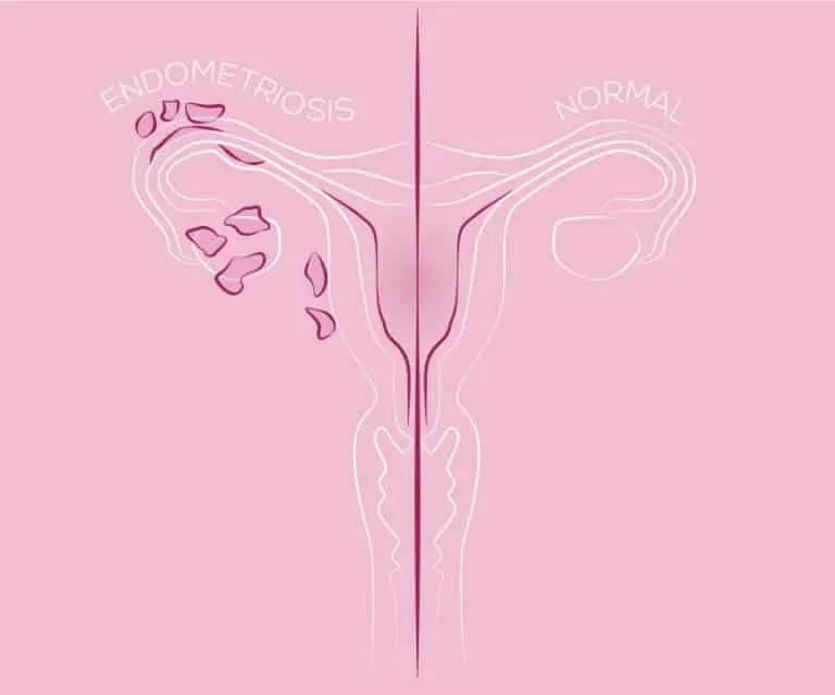 Endometriose