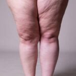 Lipedema