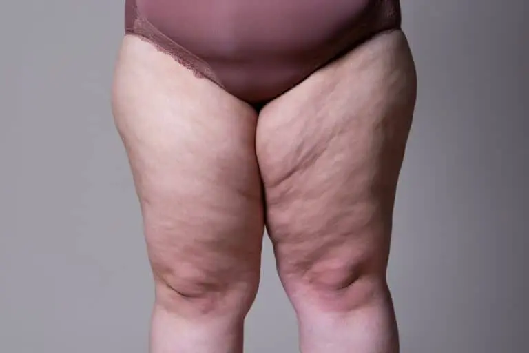 Lipedema