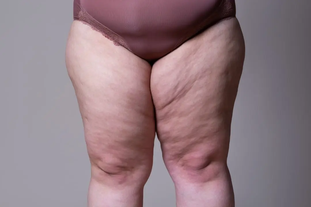 Lipedema