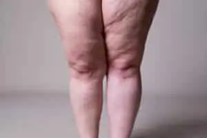 Exercícios físicos ajudam no controle do lipedema e reduzem sintomas da condição crônica