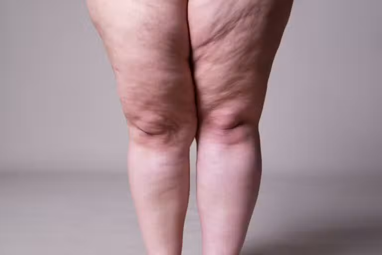Lipedema