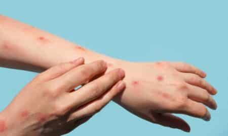 Mpox