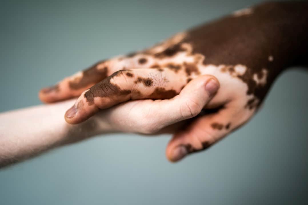 Vitiligo