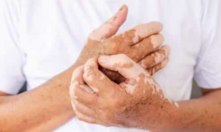 Vitiligo