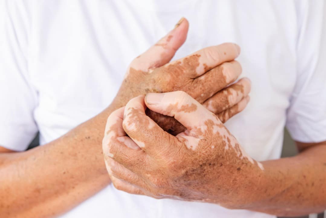 Vitiligo