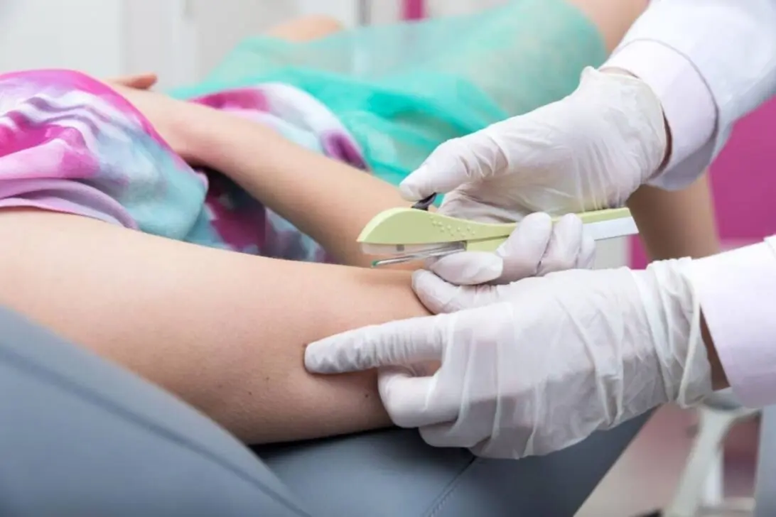 SUS avança com Implanon: 500 mil mulheres terão acesso gratuito a implante contraceptivo