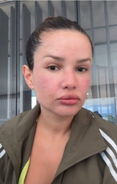 Juliette aparece com rosto inchado após procedimentos estéticos