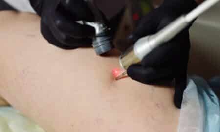 Tratamento vascular a laser