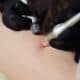 Tratamento vascular a laser