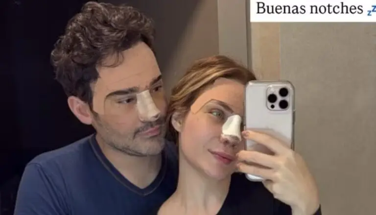 Fernando Zor e Lara Bissi Rinopplastia