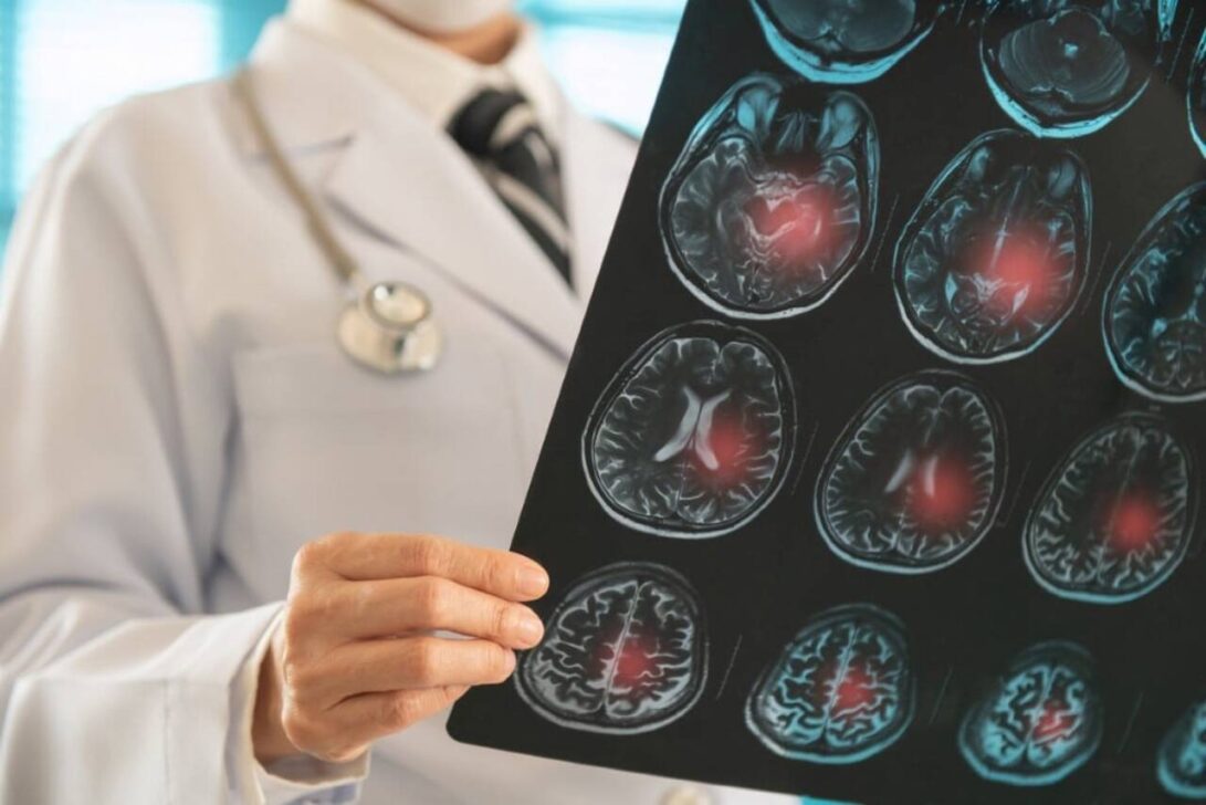 Médico analisando exame raio-x cerebral, conceito de AVC
