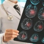 Médico analisando exame raio-x cerebral, conceito de AVC
