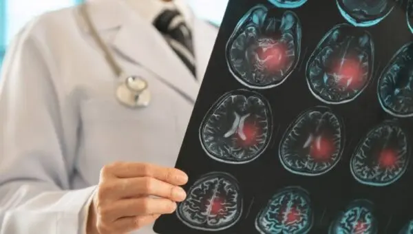 Médico analisando exame raio-x cerebral, conceito de AVC