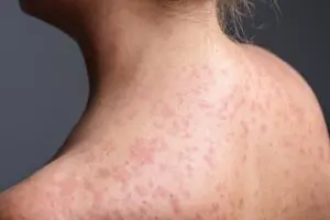 南卡羅來納州宣布麻疹疫情結束，但美國出現新的疫情