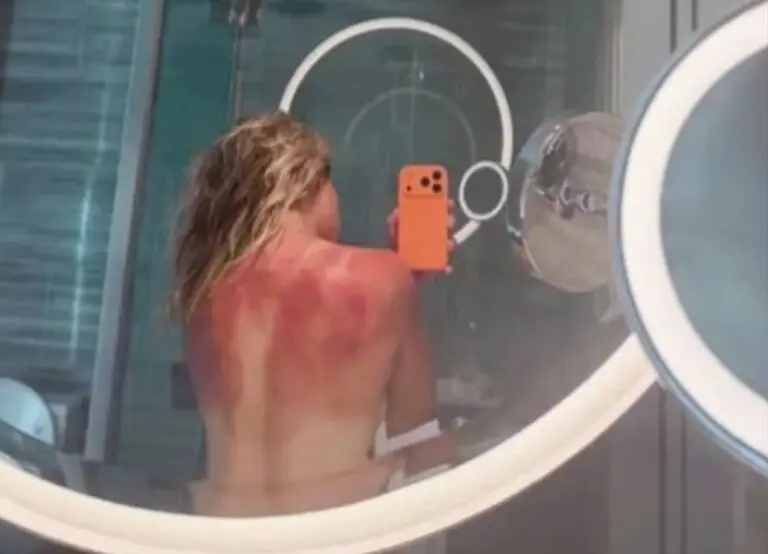 Renata Zarazua expõe queimaduras após torneio - Reprodução/Instagram