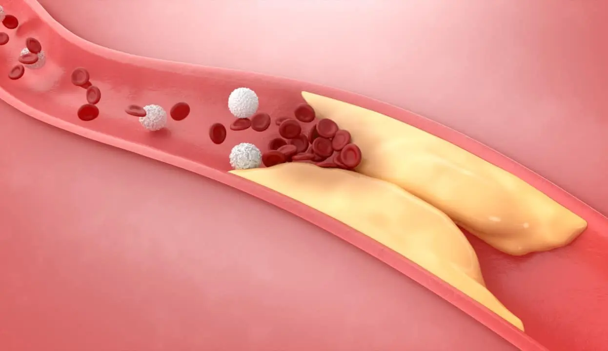 Artérias e veias espessadas, doença arterial coronariana, colesterol alto