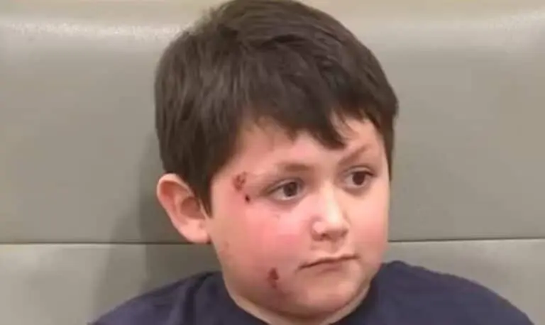 Caleb teve rosto queimado em desafio perigoso do TikTok