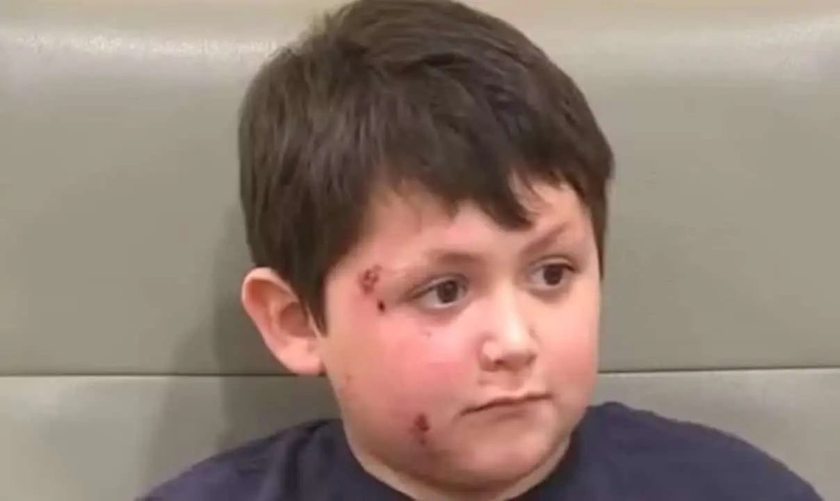 Caleb teve rosto queimado em desafio perigoso do TikTok