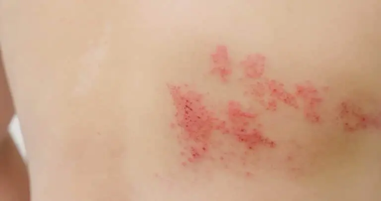 herpes