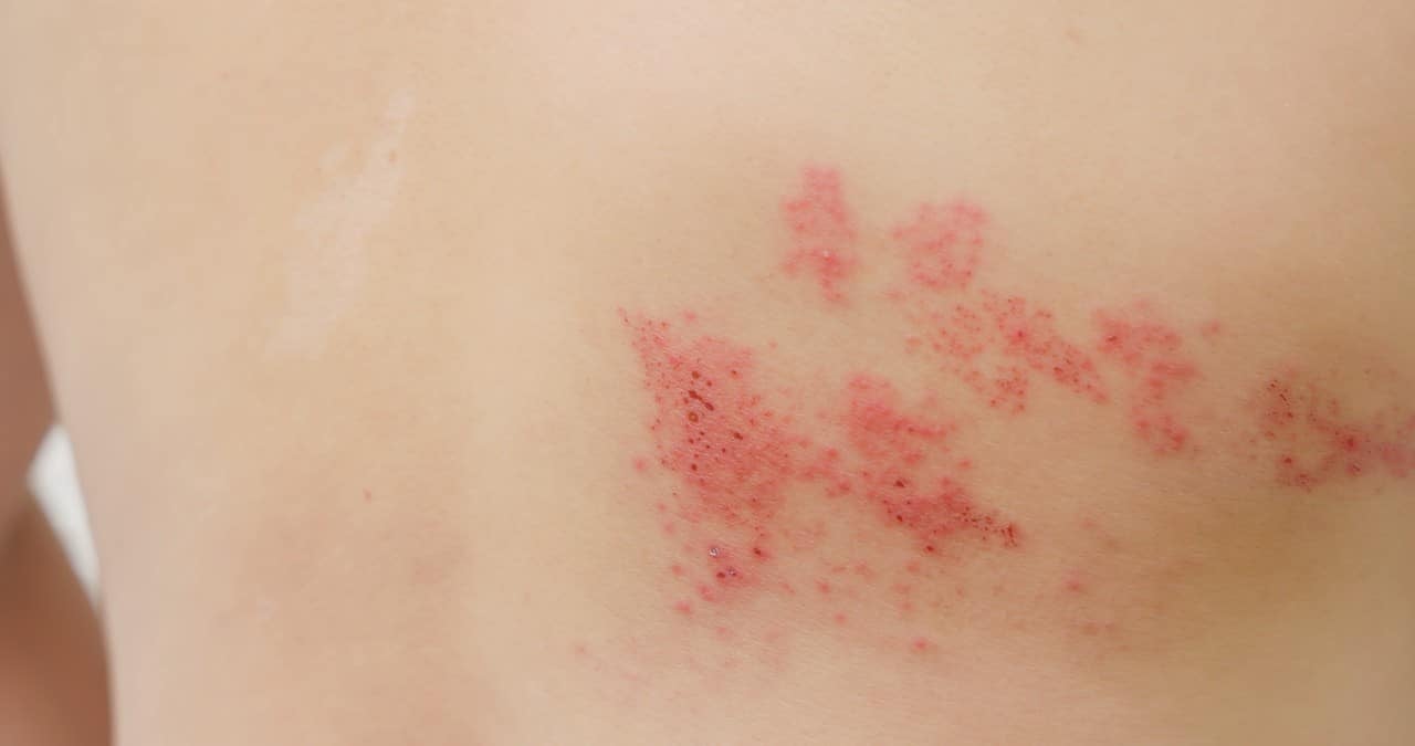 herpes