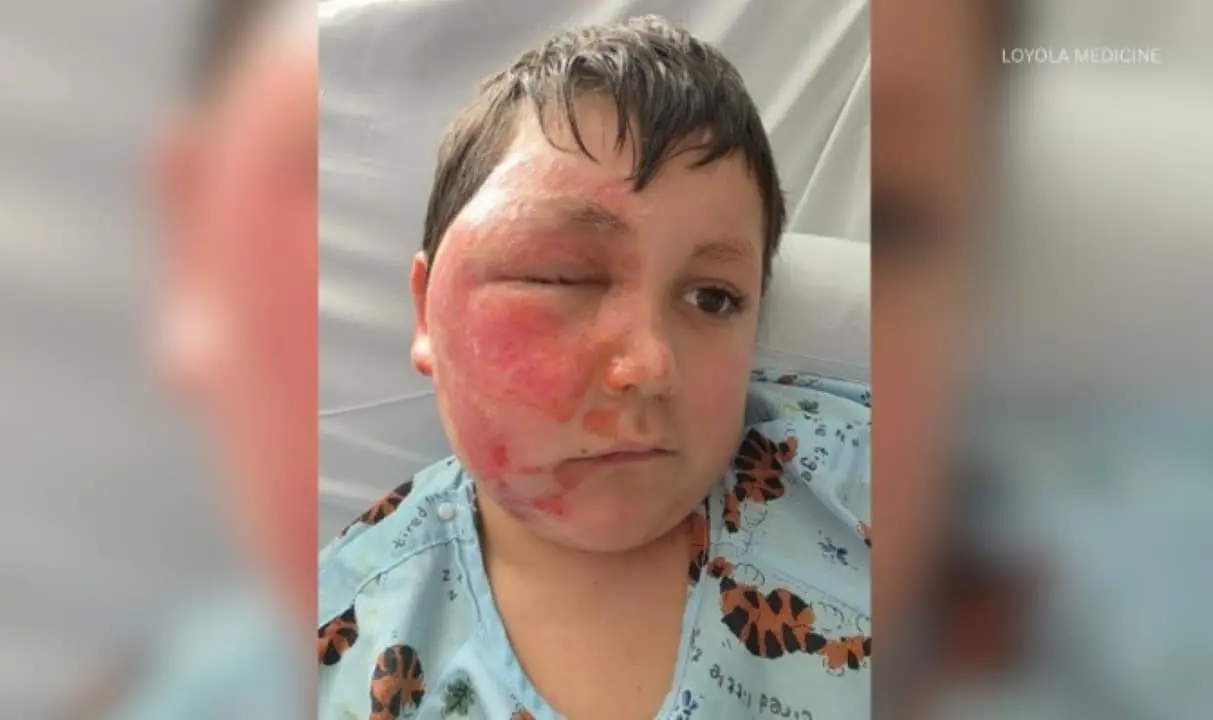 Menino de 9 anos tem rosto queimado em desafio perigoso do TikTok