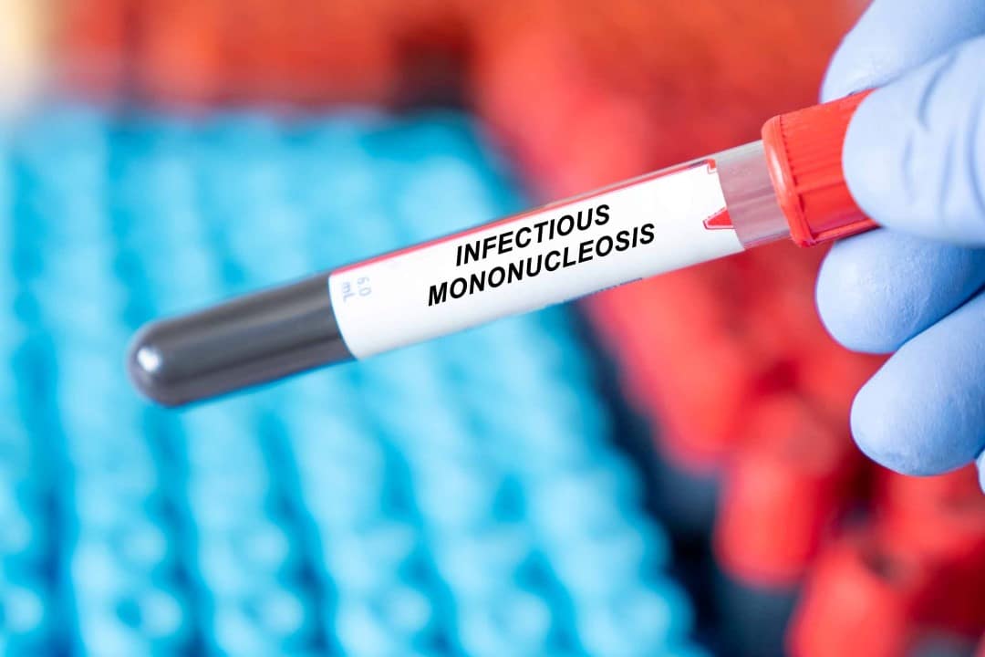 Mononucleose infecciosa