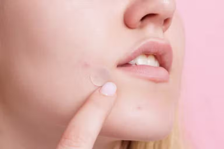 adesivo de acne