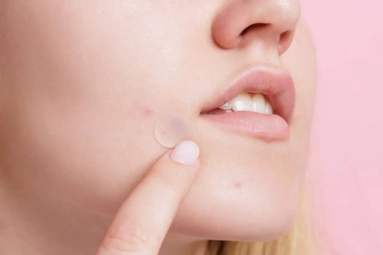 adesivo de acne