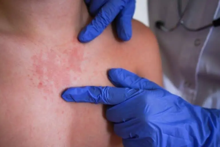 monkeypox