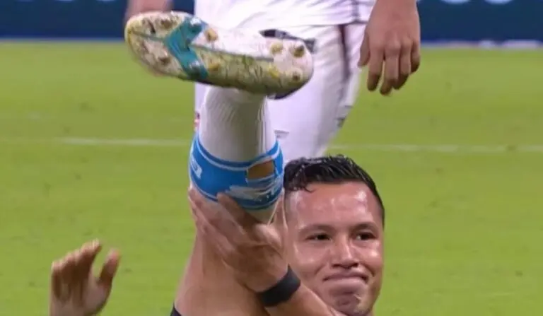 Fratura Marlon Grêmio