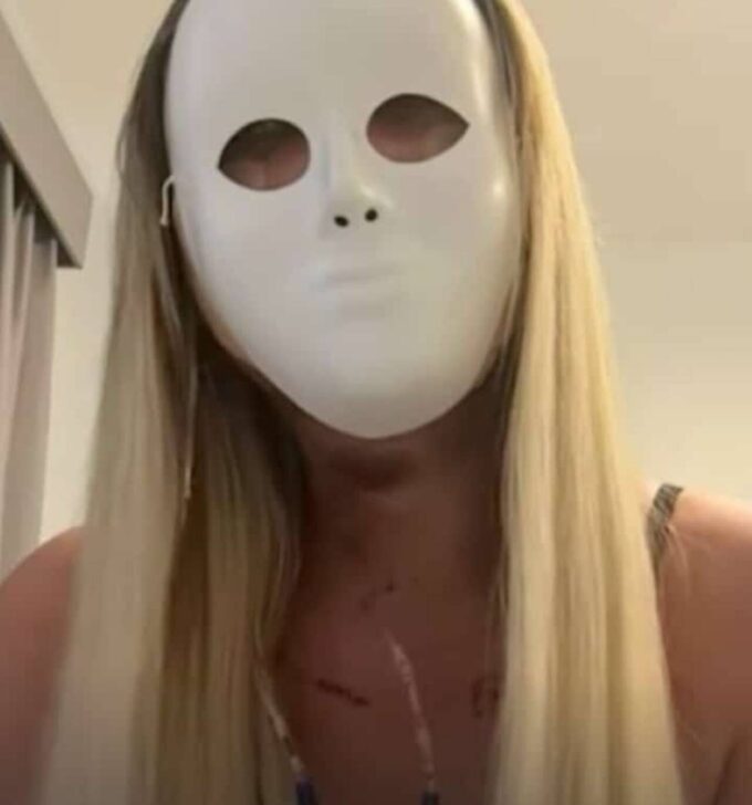 Andressa Urach faz lifting facial