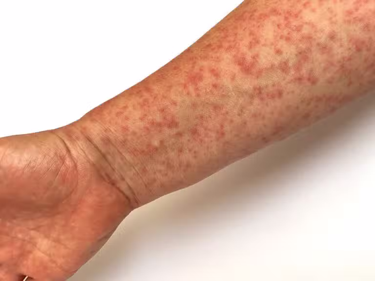 sarampo