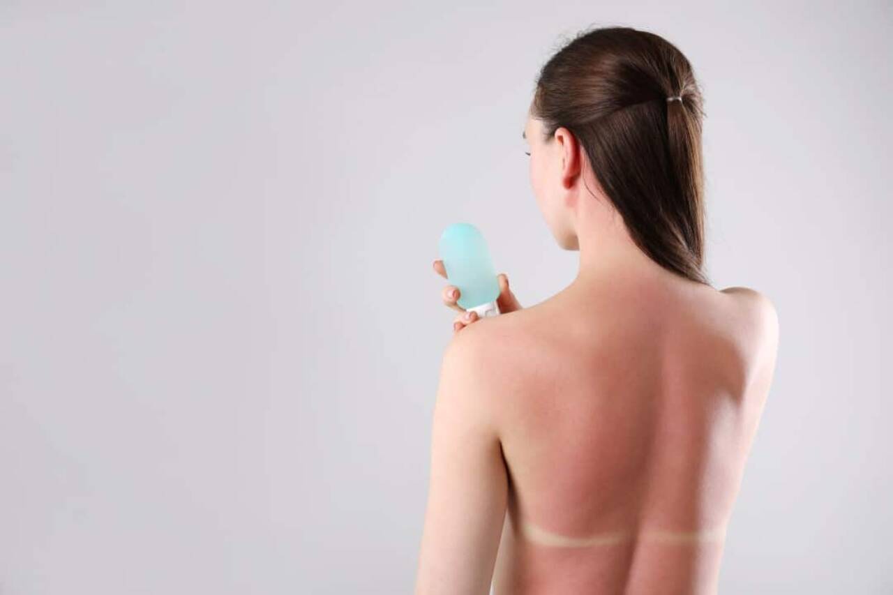 Verbrande vrouw, zonnesteek