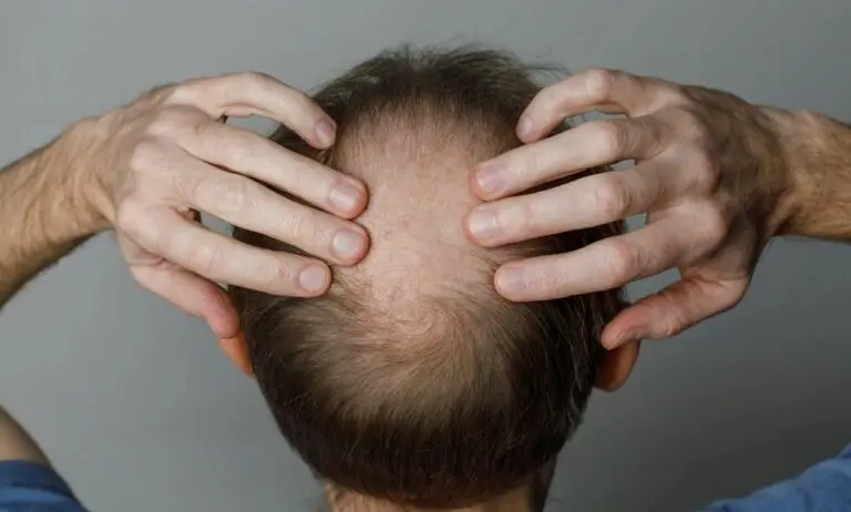 Calvice - JNemchinova/Istock.com