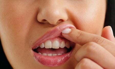 Dentes gengiva