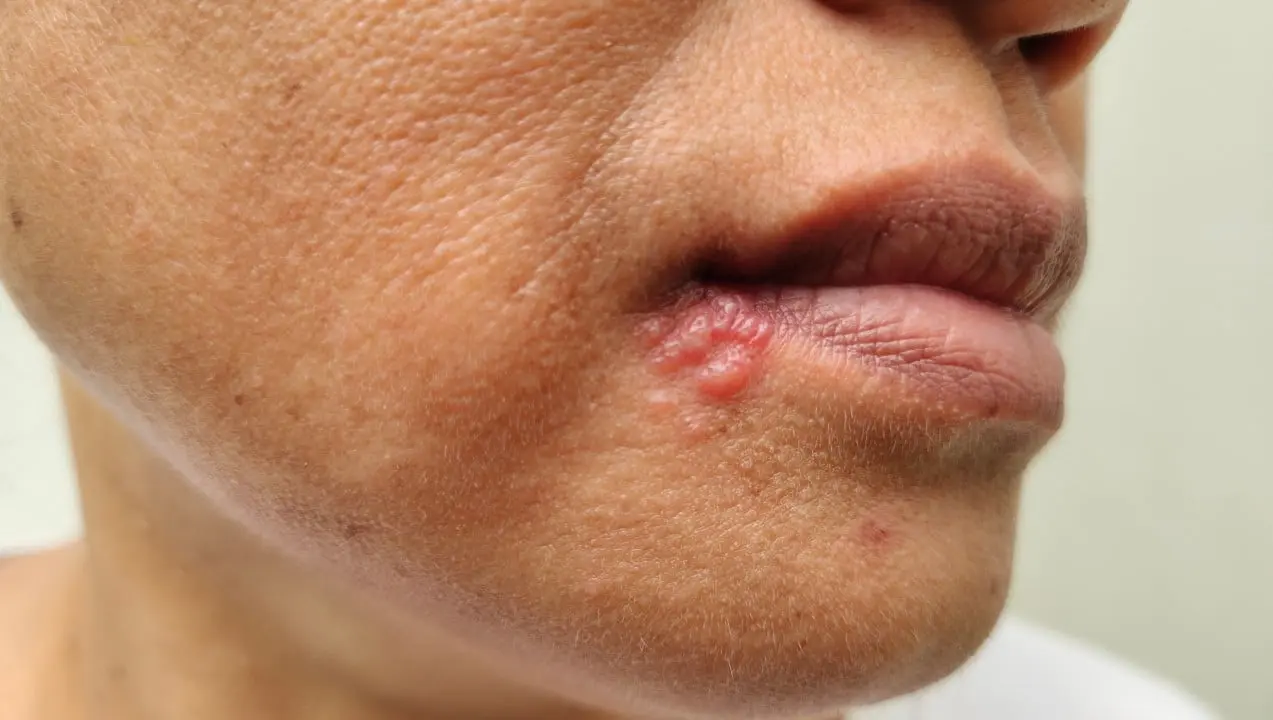 herpes