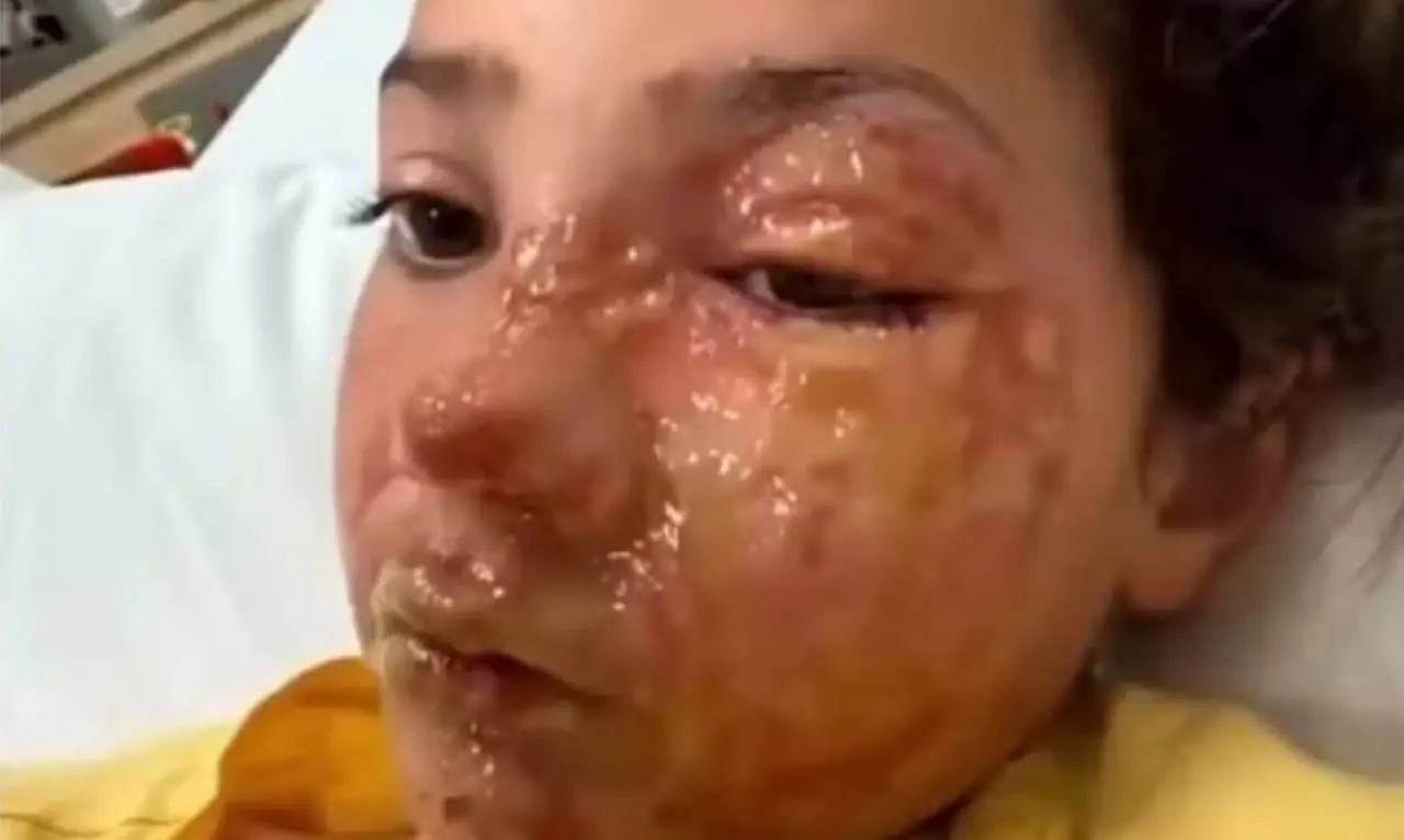 Violet sofre queimaduras no rosto após participar de desafio viral - Reprodução