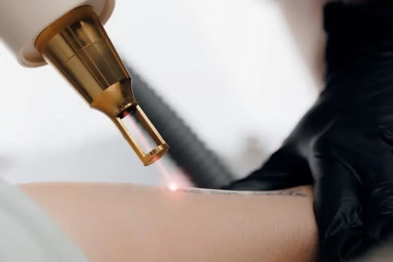 Remoção de tatuagem