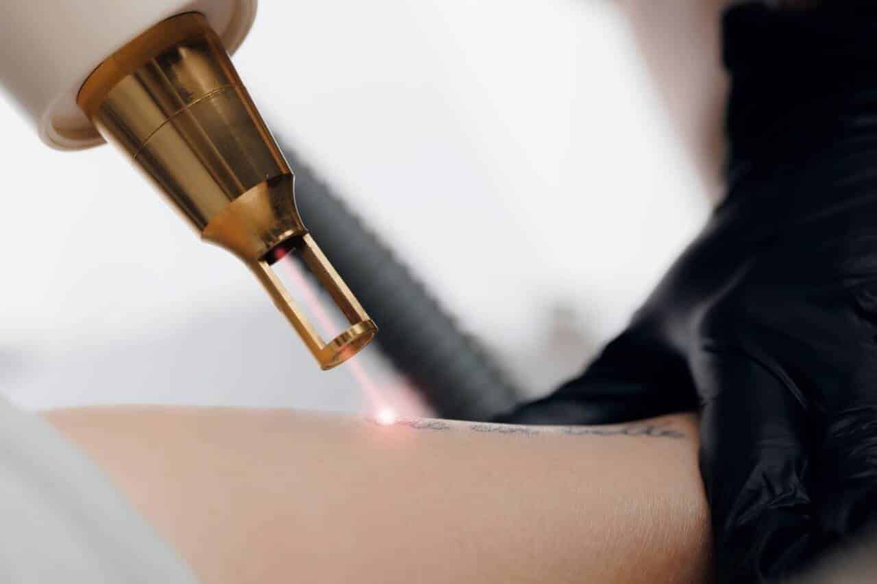 Remoção de tatuagem