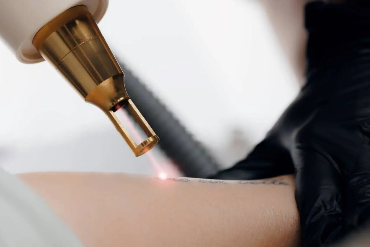 Remoção de tatuagem