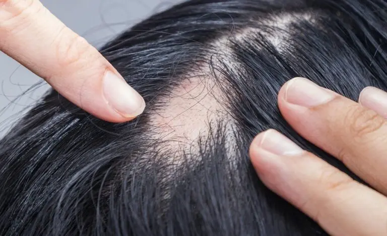 Alopecia - gopfaster/Istock.com