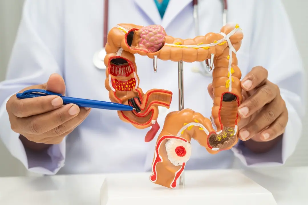 Câncer colorretal, médico segurando intestino modelo humano de cólon
