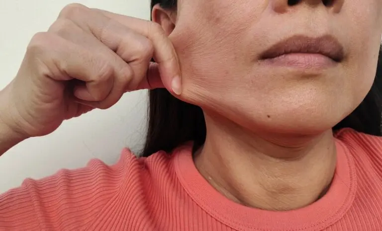 Face de mulher, Flacidez Facial