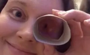 Cirurgia para câncer na cavidade ocular faz mulher desenvolver habilidade inusitada