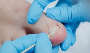 Unha encravada: podólogos e dermatologistas revelam riscos do corte errado e como evitar
