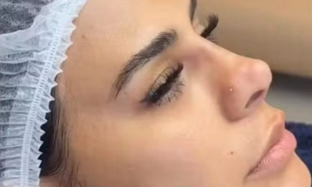 Simone Mendes nega rinoplastia e explica uso de fios no nariz