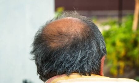 Homem calvo - tanitost / shutterstock.com